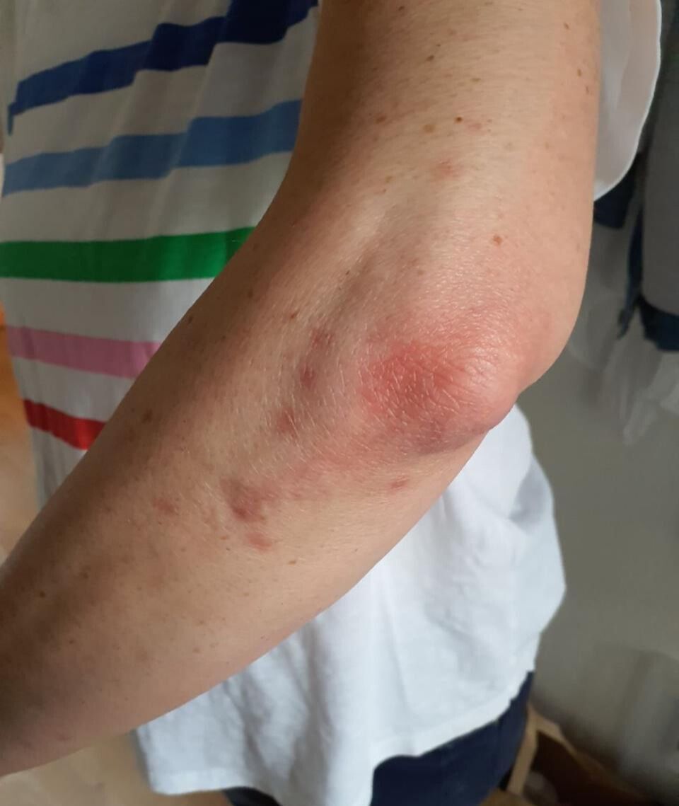  Eine Person in Erlenbach (8703, Kanton Zürich) zeigt an ihrem Ellenbogen Hautreizungen und rote Flecken, die auf Insektenstiche hinweisen könnten.