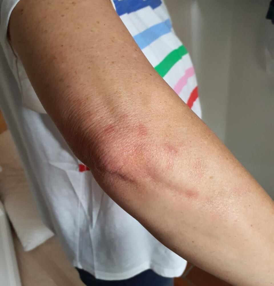 In Hombrechtikon (8634, Kanton Zürich) sind an einem Arm Hautrötungen und Bissspuren zu sehen, die möglicherweise von Bettwanzen stammen.